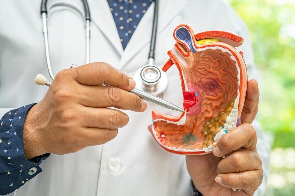 این علائم از سرطان معده خبر میدهند این علائم از سرطان معده خبر میدهند