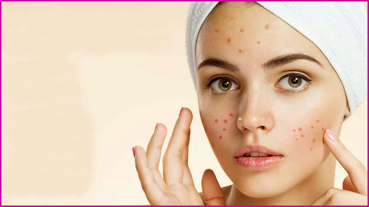 لمس صورت باعث بروز آکنه میشود؟ / مقصران واقعی جوشهای پوست لمس صورت باعث بروز آکنه میشود؟ / مقصران واقعی جوشهای پوست