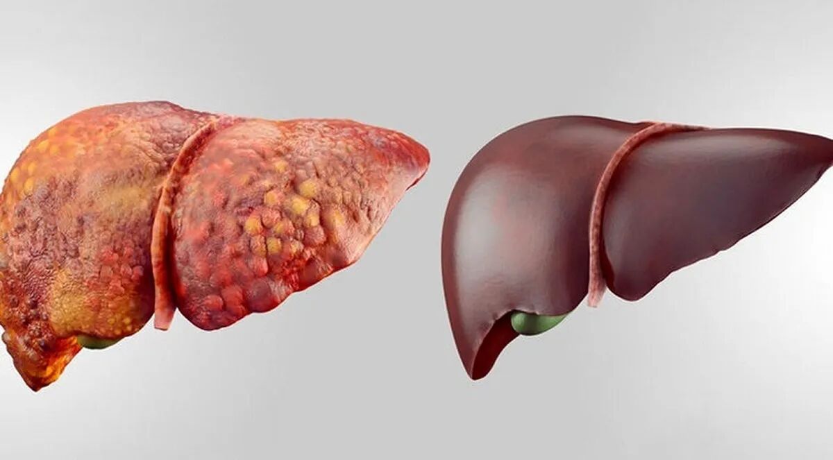 معجزه این ۴ نوشیدنی برای درمان کبد چرب معجزه این ۴ نوشیدنی برای درمان کبد چرب