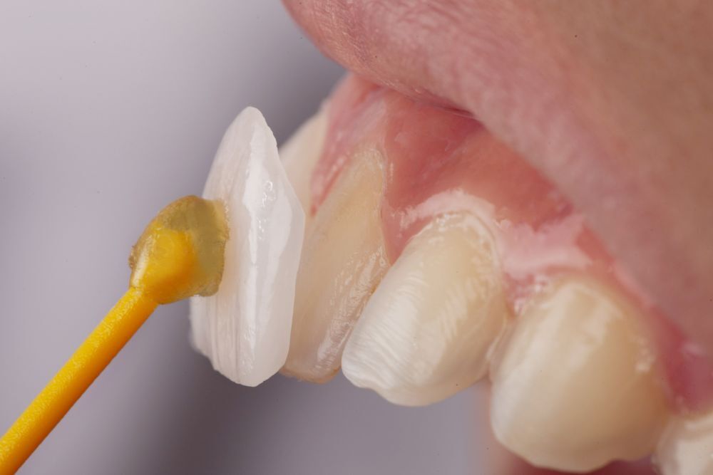 سن مناسب لمینت دندان، چند سال است؟ سن مناسب لمینت دندان، چند سال است؟