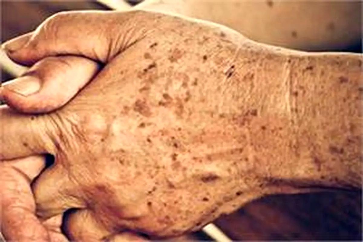 لکه های پوستی از کجا می آیند؟ لکه های پوستی از کجا می آیند؟