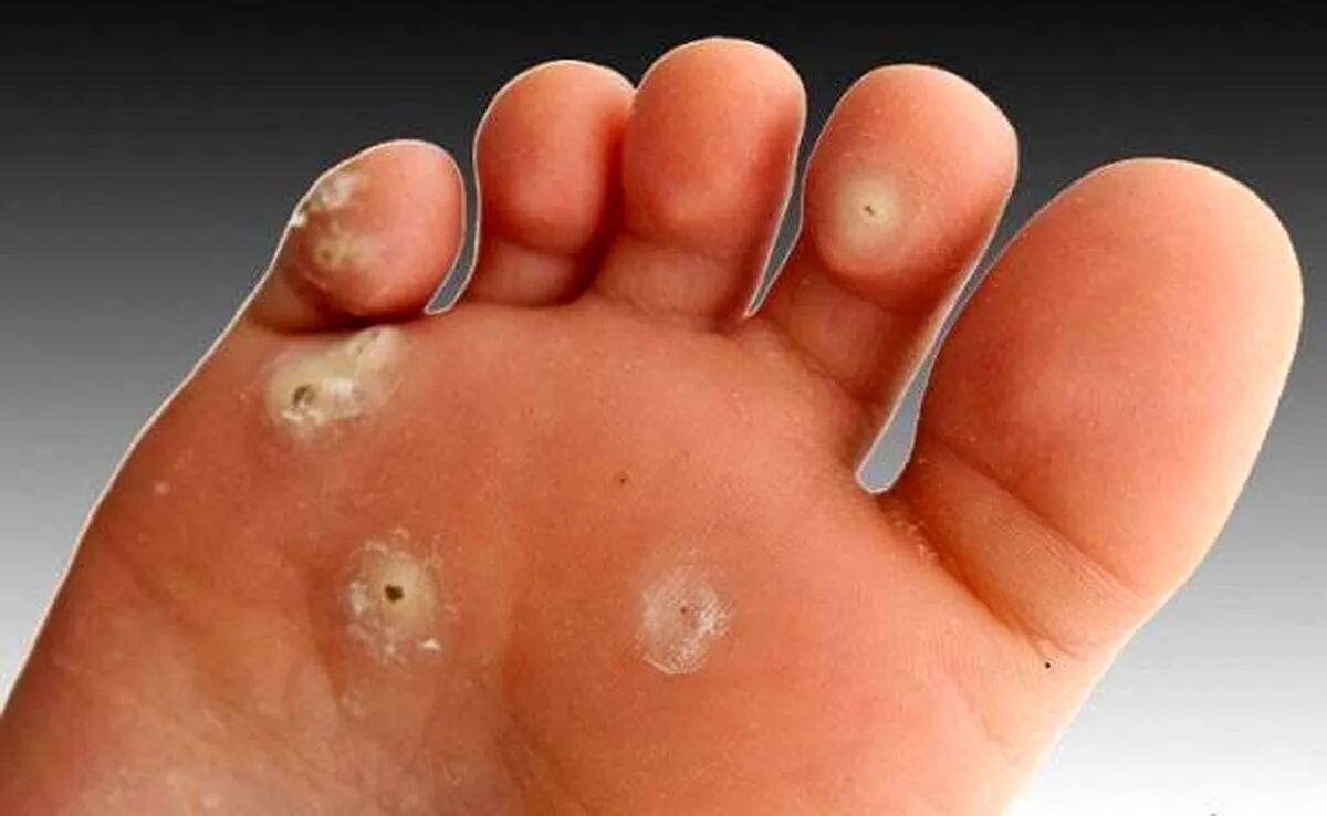چرا پا «میخچه» میزند؟ چرا پا «میخچه» میزند؟