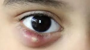 آیا کیست چشم خطرناک است؟ آیا کیست چشم خطرناک است؟