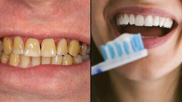 چرا دندانها زرد میشوند و چه باید کرد؟ چرا دندانها زرد میشوند و چه باید کرد؟