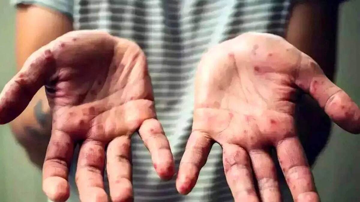 ویروس آبله میمونی واکسن دارد؟ / نکاتی مهم درباره آبله میمونی ویروس آبله میمونی واکسن دارد؟ / نکاتی مهم درباره آبله میمونی
