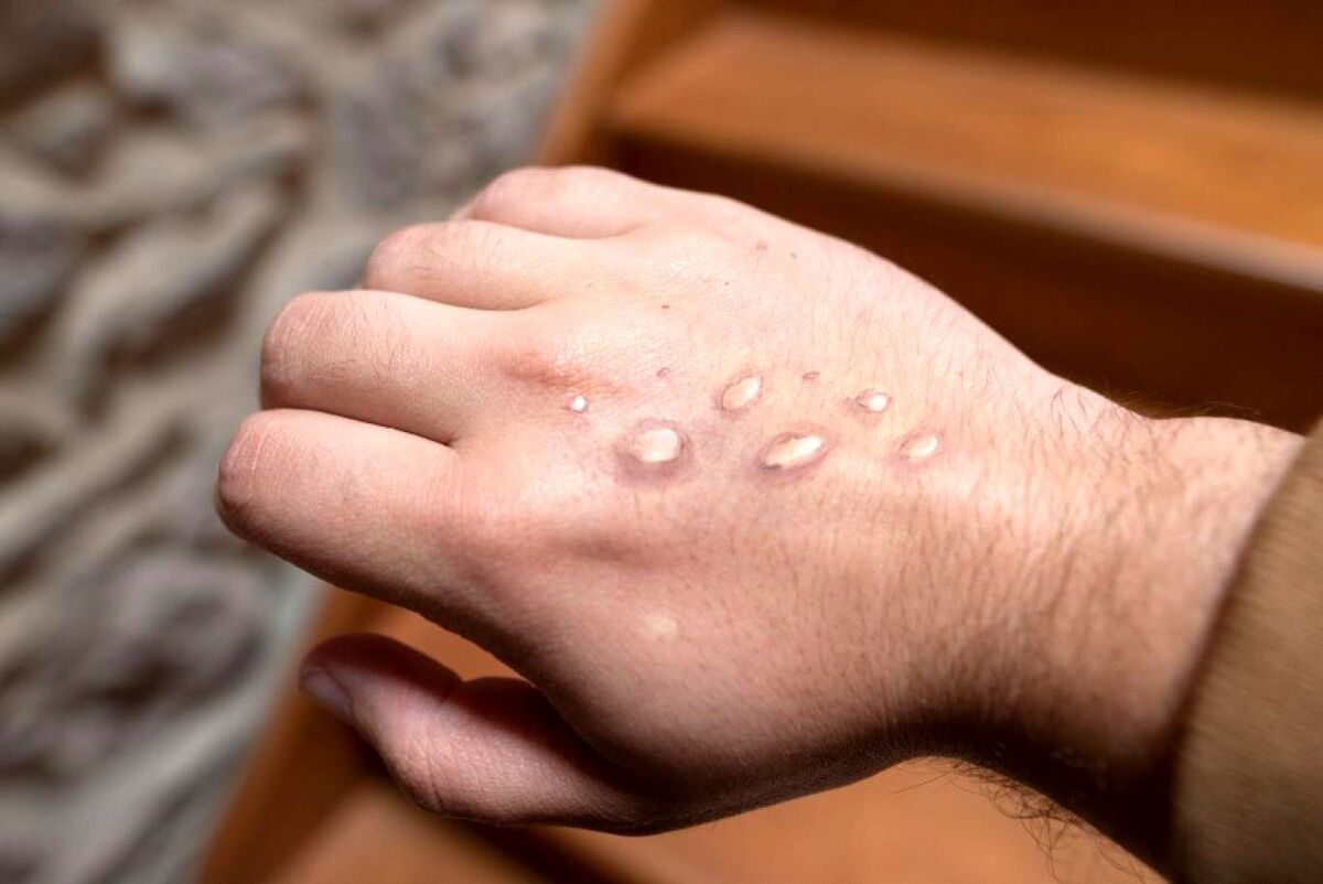 اولین واکسن آبله میمونی تایید شد اولین واکسن آبله میمونی تایید شد