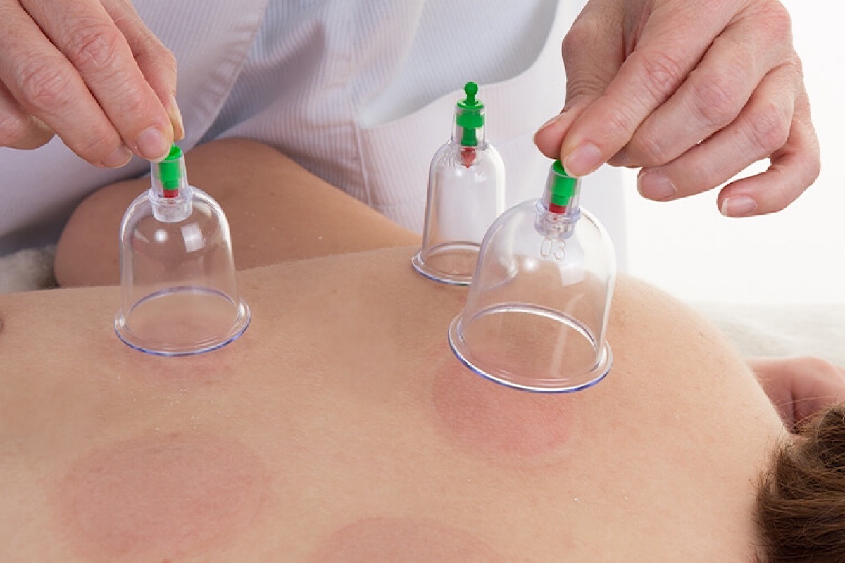 حجامت؛ معایب، خطرات و نکات ضروری برای تصمیمگیری حجامت؛ معایب، خطرات و نکات ضروری برای تصمیمگیری