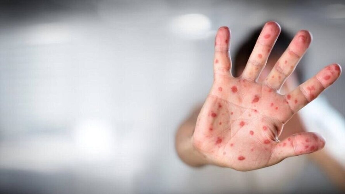 آخرین وضعیت آبله میمونی در کشور آخرین وضعیت آبله میمونی در کشور