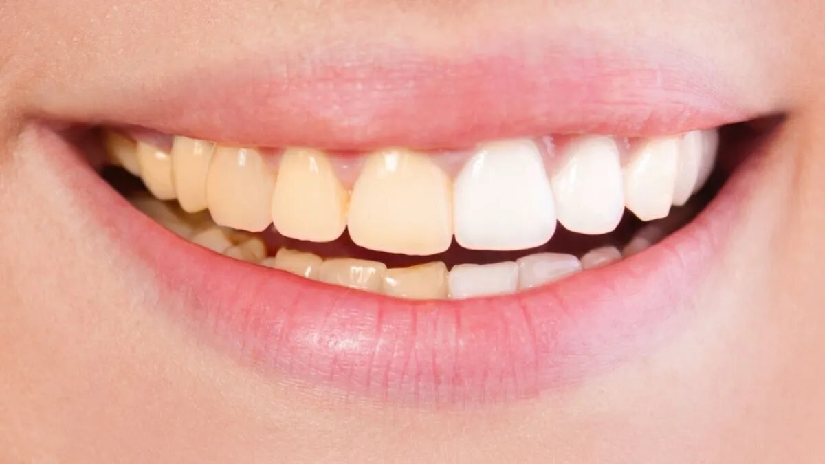 چطور از زرد شدن دندانها جلوگیری کنیم؟ چطور از زرد شدن دندانها جلوگیری کنیم؟