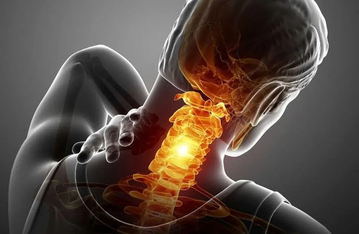 فتق دیسک گردن چیست و چه علائمی دارد؟ فتق دیسک گردن چیست و چه علائمی دارد؟