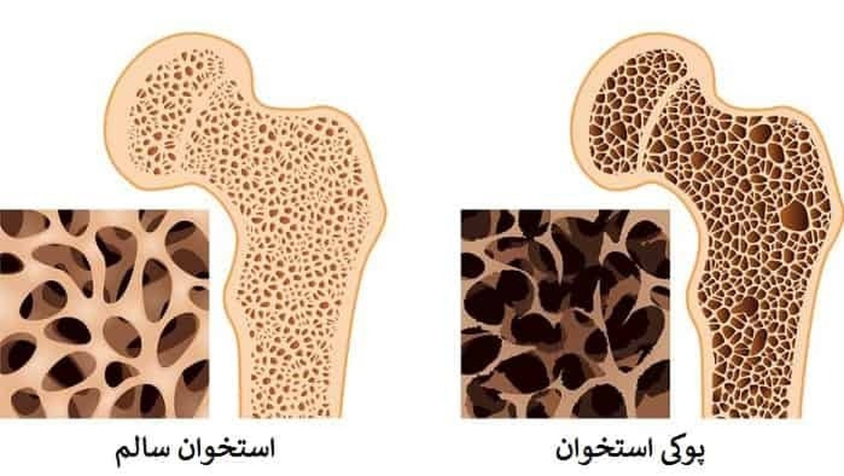 تشخیص پوکی استخوان از روی علائم دندان تشخیص پوکی استخوان از روی علائم دندان