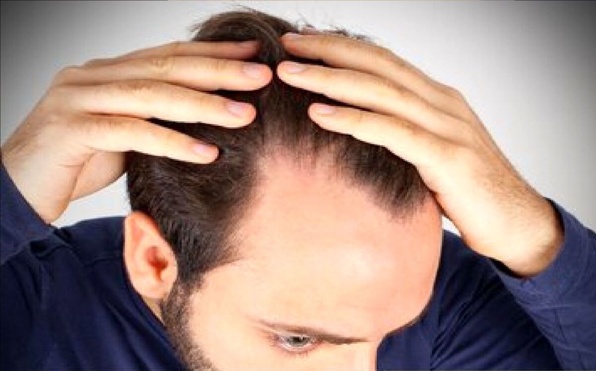 ریزش مو می تواند نشانه ای از این بیماری جدی باشد ریزش مو می تواند نشانه ای از این بیماری جدی باشد