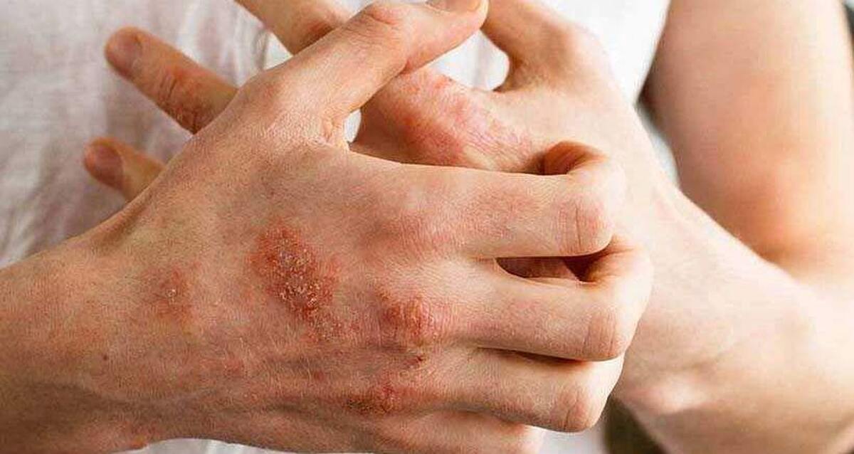 علائم، علل، و روشهای مؤثر درمان اگزما علائم، علل، و روشهای مؤثر درمان اگزما