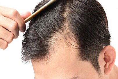 بررسی دلایل روانشناختی ریزش مو