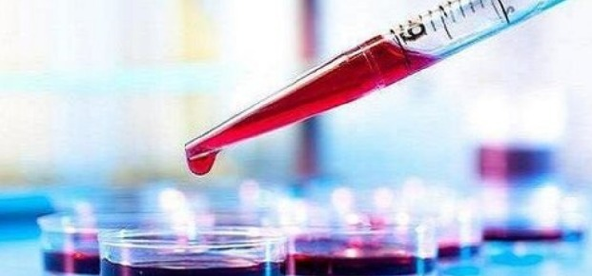 تشخیص آلزایمر با یک آزمایش ساده تشخیص آلزایمر با یک آزمایش ساده