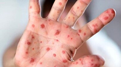 زنگ خطر شیوع بیماری کشنده در یزد به صدا درآمد