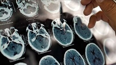 اینفوگرافیک/ چرا دچار تیک عصبی می شویم؟