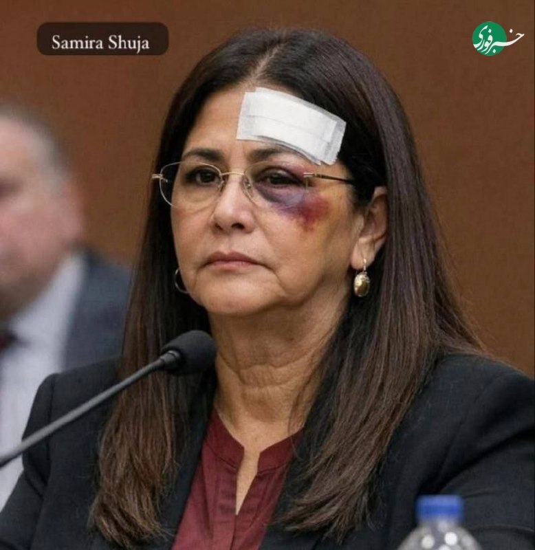 عکسی از چشم کبود همسر مادورو / سیلیا فلورس شکنجه شد؟ عکسی از چشم کبود همسر مادورو / سیلیا فلورس شکنجه شد؟