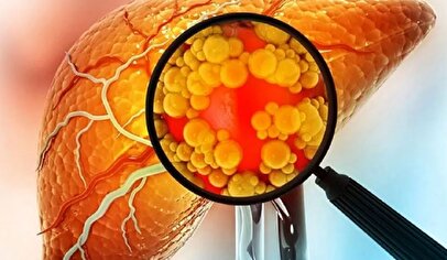 تشخیص کبد چرب از روی چهره/ علائمی که به ما هشدار می‌دهند