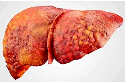 اینفوگرافیک / کبد شما چقدر چرب است؟! درجه‌بندی کبد چرب را بشناسید