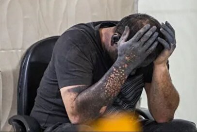 گام‌های حیاتی در درمان سوختگی‌های شدید در شرایط جنگی و انفجار