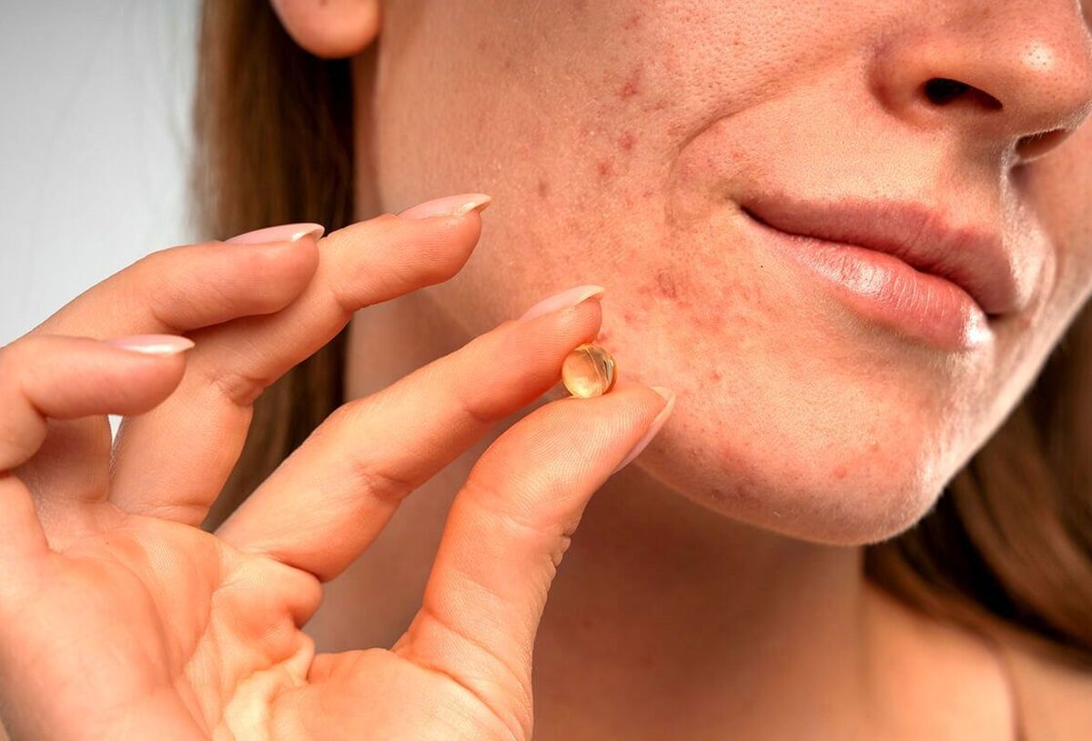  جوش صورت با مصرف قرص استامینوفن بر طرف می‌شود؛ درمان موثر یا اشتباه رایج؟ 