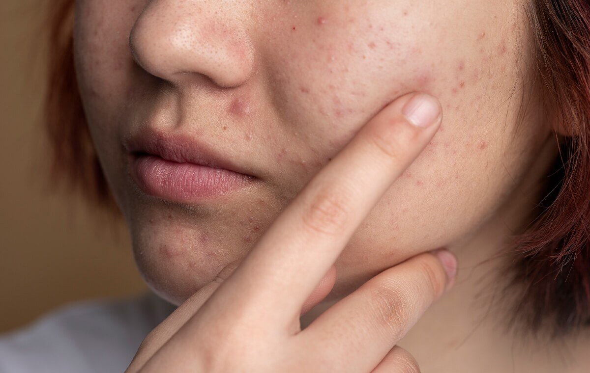 جوش صورت با مصرف قرص استامینوفن بر طرف می‌شود؛ درمان موثر یا اشتباه رایج؟
