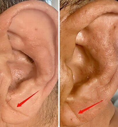 چین‌خوردگی‌های لاله گوش، خبر از یک بیماری مهم می‌دهد+ عکس