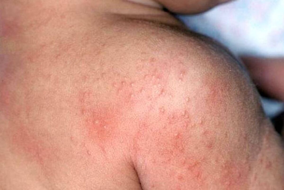 نخستین نشانه‌ها از سرطان پوست را جدی بگیرید