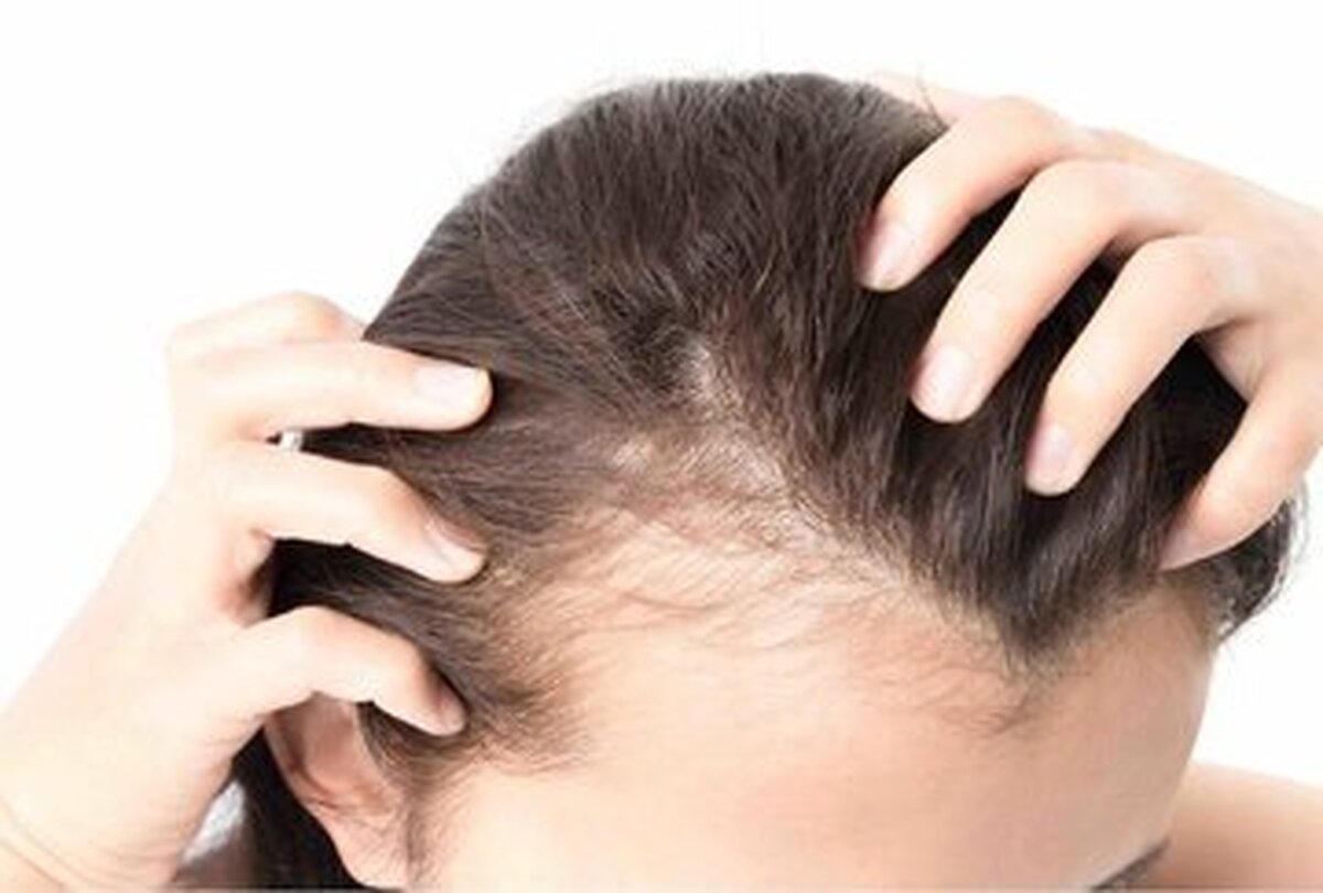 درمان ریزش مو با تغییر در چهار عادت