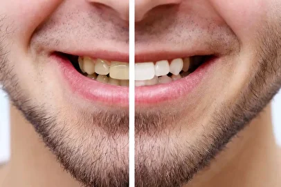 دندان‌هایی سفید مثل برف/ نقش ویتامین‌ها در سلامت و زیبایی دهان