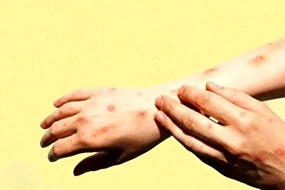 شناسایی هزار و ۱۰۷ بیمار مبتلا به تب دنگی در کشور / کدام استان‌ها درگیر این بیماری هستند؟