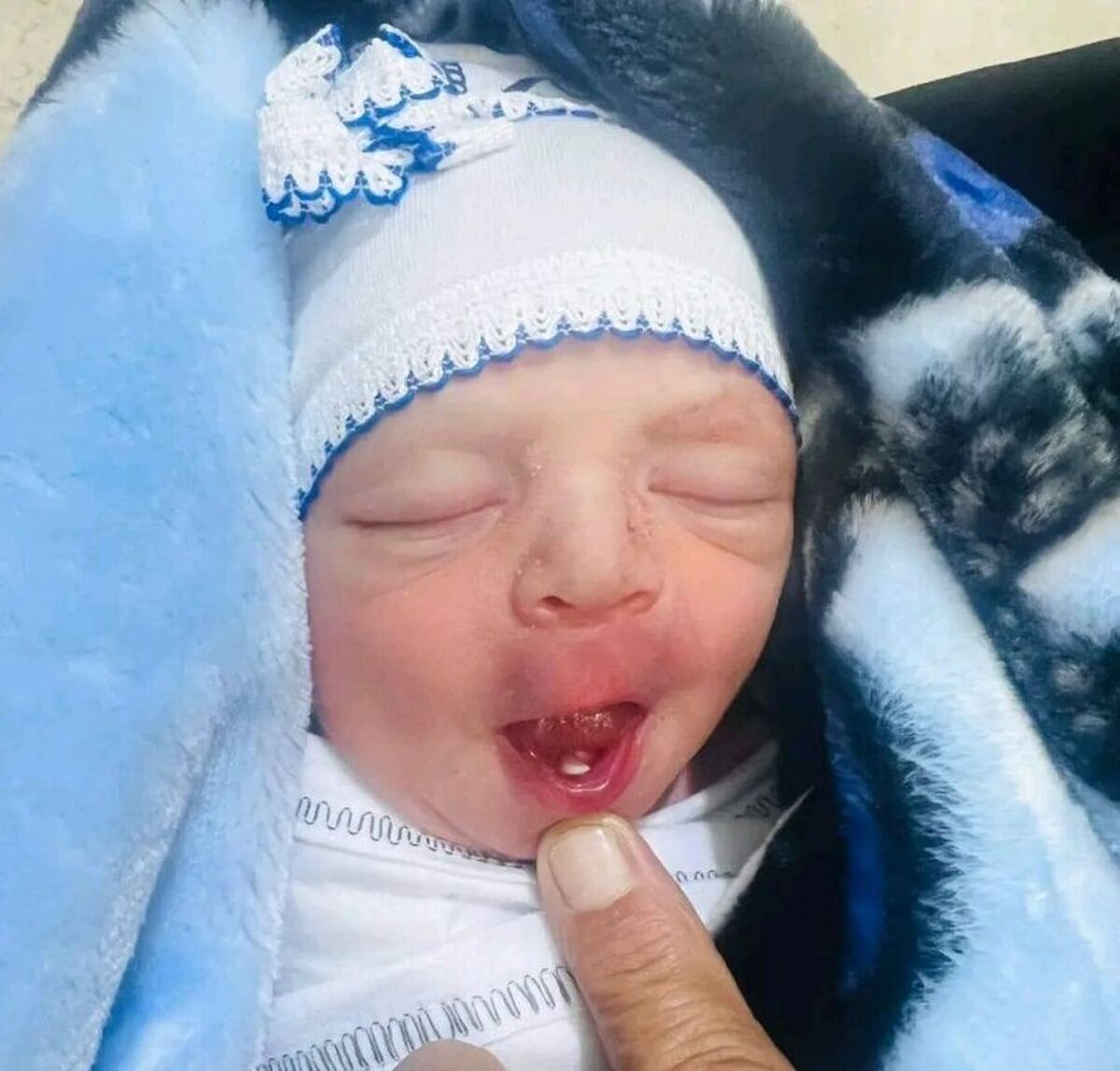 یک اتفاق نادر/ تولد یک نوزاد با دندان در بابل + تصویر