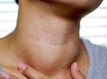 اگر این علائم را دارید به پزشک مراجعه کنید/ تیروئید شما کم‌کار است