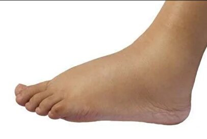 ورم ناگهانی پا چرا خطرناک است؟ /اگر این علائم را دارید به پزشک مراجعه کنید