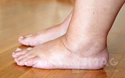 ورم ناگهانی پا چرا خطرناک است؟