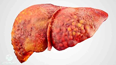 هشدار پزشک درباره کبد چرب/بیماری خاموش در کمین سبک زندگی ناسالم