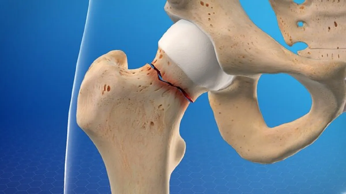 کاهش خطر شکستگی لگن با این ماده معدنی
