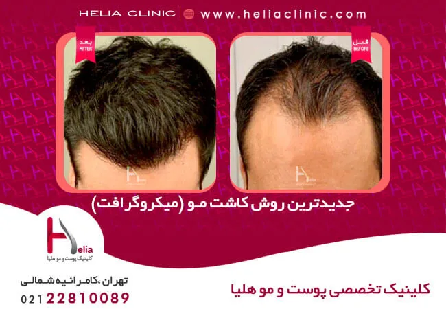مقایسه روش های کاشت مو و ابرو در کلینیک هلیا