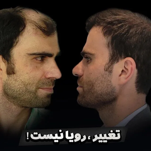 بهترین دکتر کاشت مو در تهران