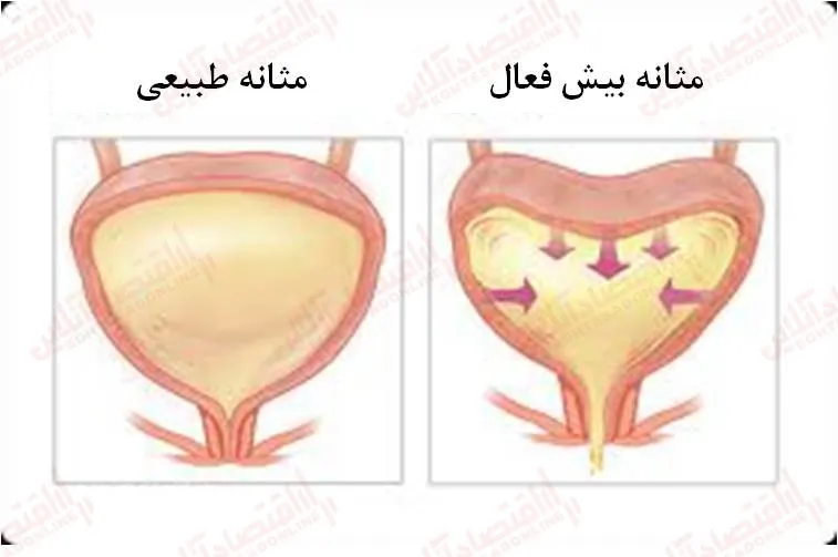 التهاب مثانه چیست؟
