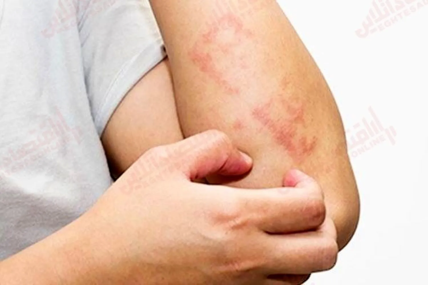 التهاب پوستی ناشی از استرس