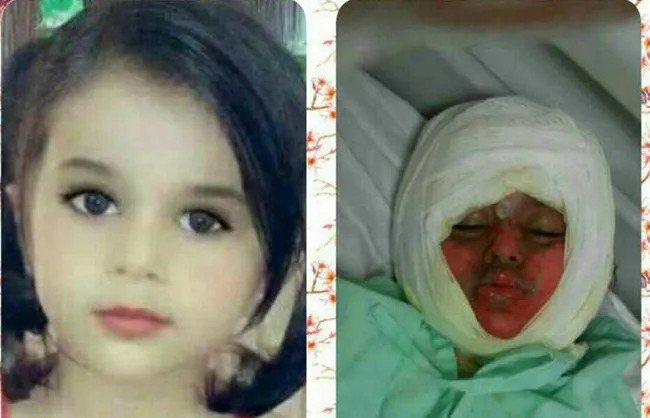 دخترک سوخته در دیگ نذری، جان سپرد +عکس