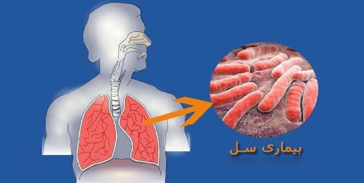 بیماری سل قابل درمان است