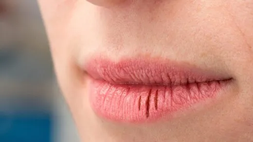 علت ترک خوردن لب ها چیست؟