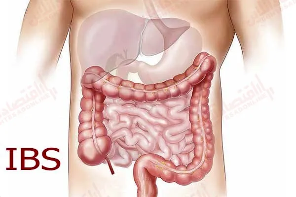 ۱۲ خوراکی که در صورت ابتلا به بیماری IBS باید از آن‌ ها اجتناب کنید