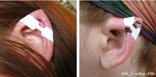 همه‌چیز درباره عمل زیبایی گوش!