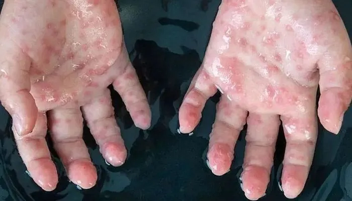 آبله میمون به جمهوری چک رسید