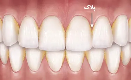 چند روش طبیعی برای خلاصی از جرم دندان
