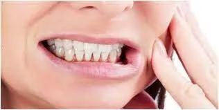 ترک دندان قروچه با این روش